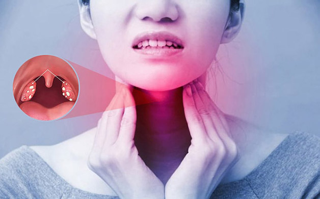 biến chứng của amidan hốc mủ