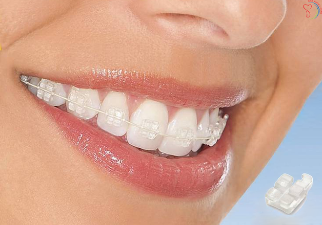 Niềng răng mắc cài sứ có chi phí cao hơn so với phương pháp niềng răng bằng mắc cài kim loại.