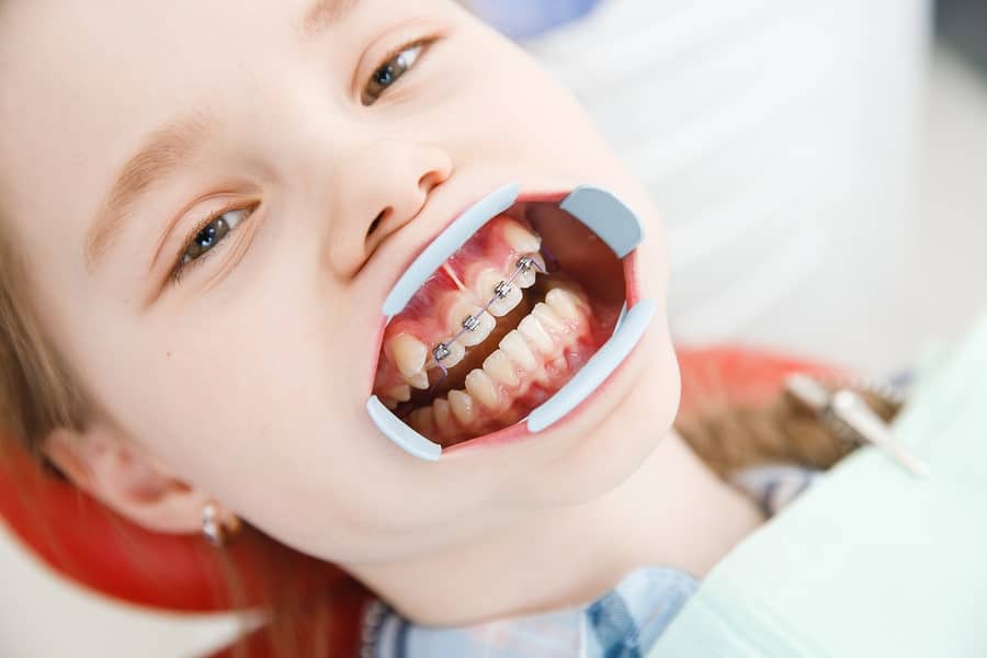 Độ tuổi niềng răng