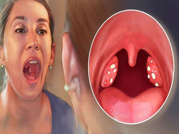 viêm amidan hốc mủ bã đậu biểu hiện như thế nào