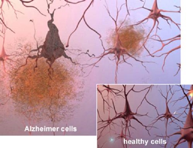 khám bệnh Alzheimer