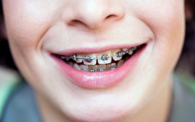 Niềng răng mắc cài kim loại gắn mặt ngoài là phương pháp ra đời đầu tiên với già thành thấp và hiệu quả cao