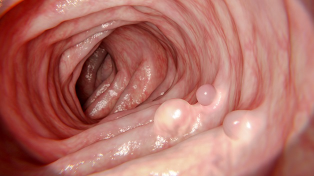Polyp trực tràng là gì?