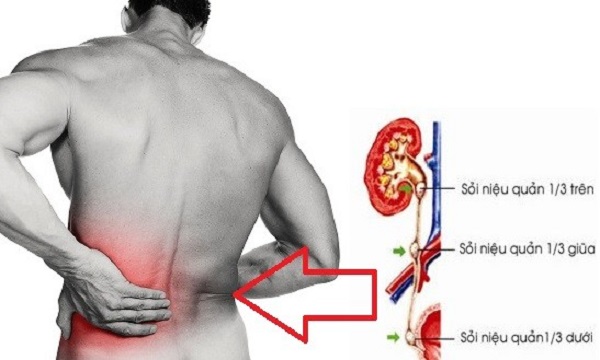 Sỏi kẹt niệu quản có thể gây ra những biến chứng vô cùng nguy hiểm