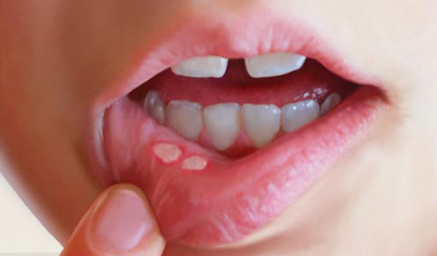 bị lở miệng có nguy hiểm không