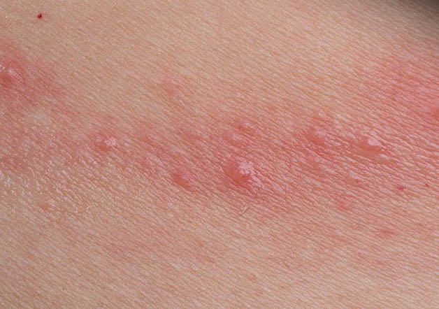Bị ngứa vùng kín nam giới bôi thuốc gì