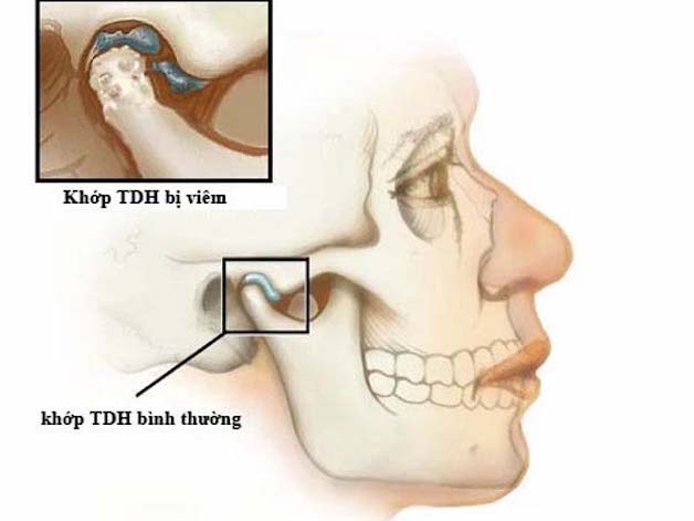 tìm hiểu về bệnh viêm khớp hàm