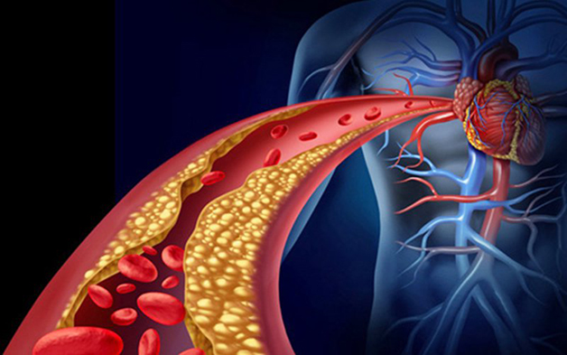 Rối loạn lipid máu