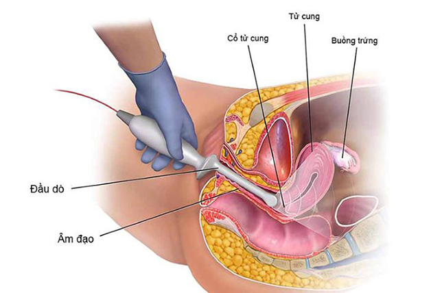 Siêu âm tử cung phần phụ