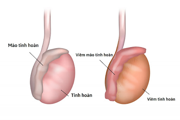 Viêm tinh hoàn là gì