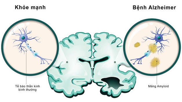 alzheimer là gì