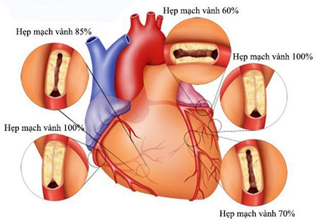 Bệnh hẹp mạch vành là bệnh lý đặc trưng bởi tình trạng giảm lưu lượng máu qua mạch vành bởi sự hình thành và phát triển của các mảng xơ vữa động mạch.