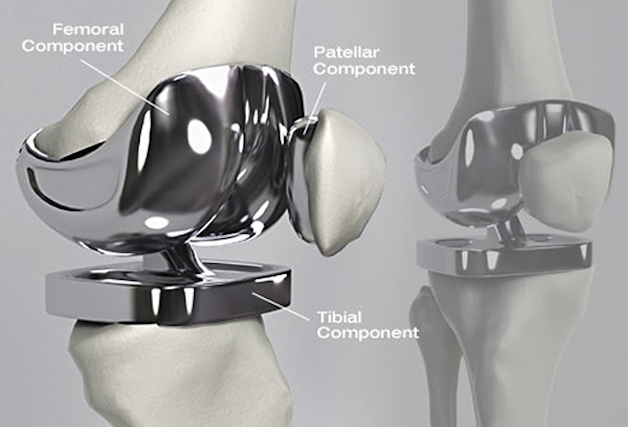 thoái hóa khớp gối và cách điều trị như thế nào