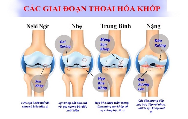 viêm thoái hóa khớp gối là gì