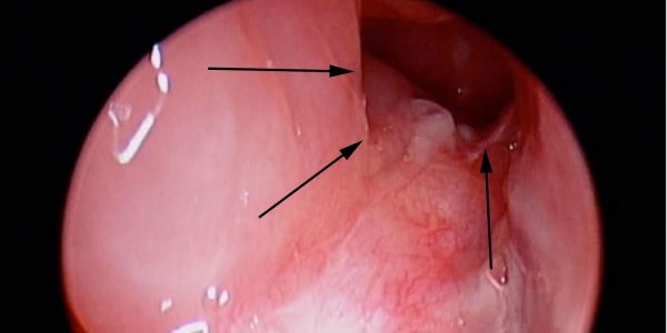 Polyp cổ tử cung là hiện tượng tăng sinh bất thường của các tế bào ở bề mặt cổ tử cung.