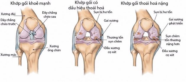 thoái hóa khớp gối có nên tập yoga hay không