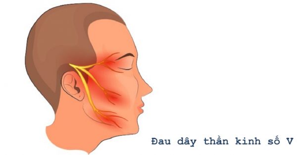 biểu hiện viêm dây thần kinh sinh ba