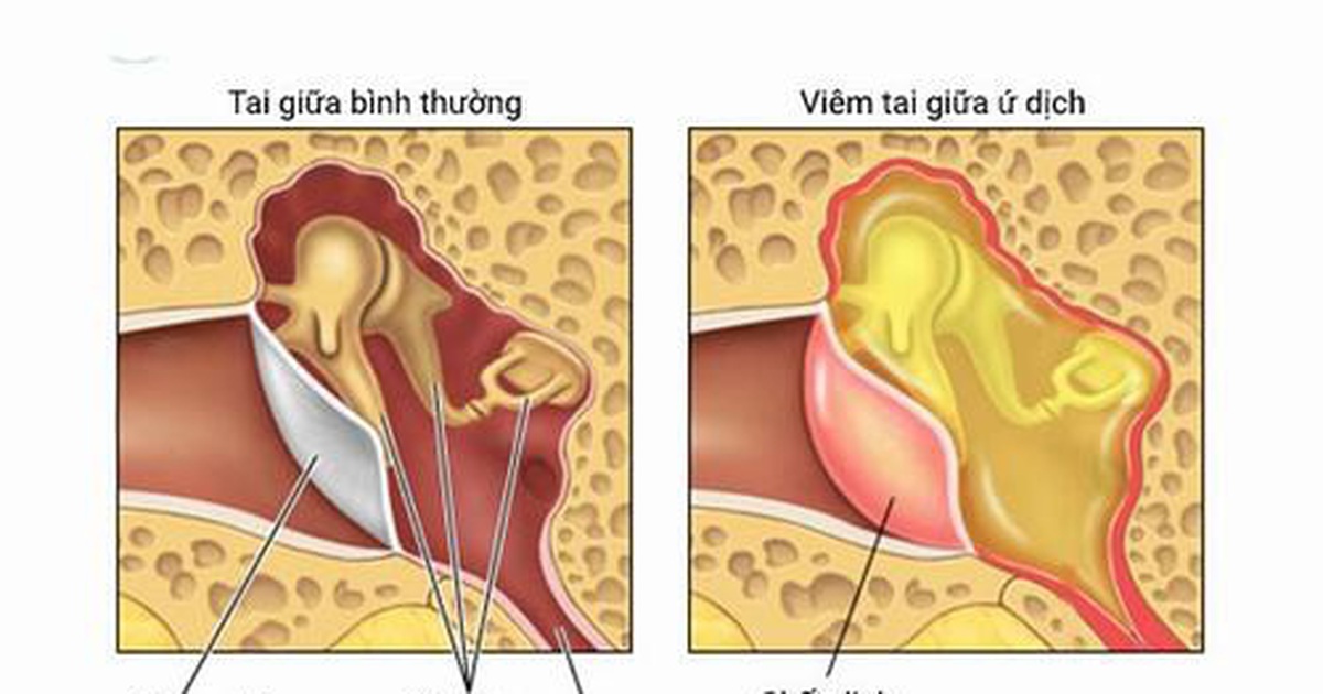 Minh họa tình trạng viêm tai giữa bằng mô hình