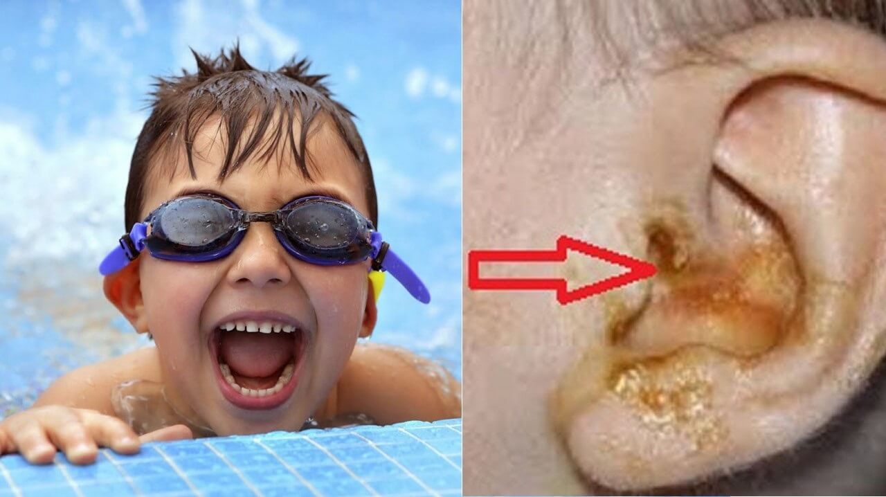 Trẻ thường xuyên bơi lội không mang dụng cụ bảo vệ tai có thể gây viêm tai giữa