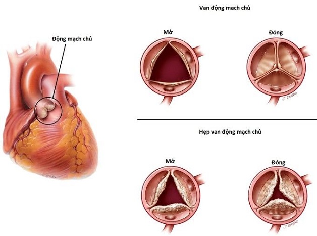 Hẹp và hở van là các bệnh lý phổ biến nhất ở van này.