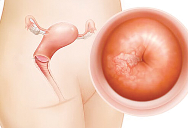 Với các bệnh nhân ung thư phụ khoa ở giai đoạn nặng, phẫu thuật cắt tử cung được xem là lựa chọn an toàn.