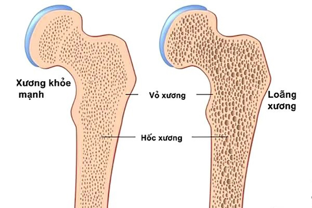 cơ chế loãng xương như thế nào
