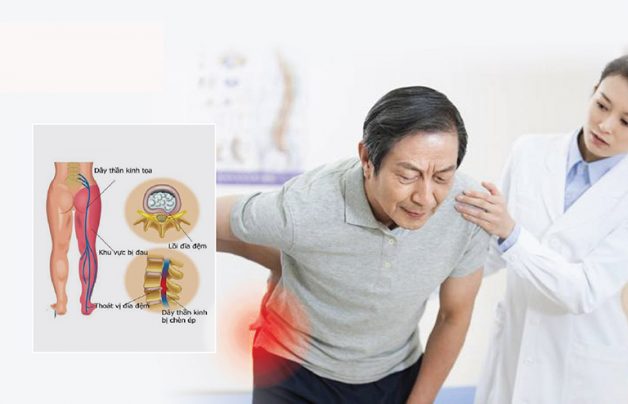 đau dây thần kinh tọa