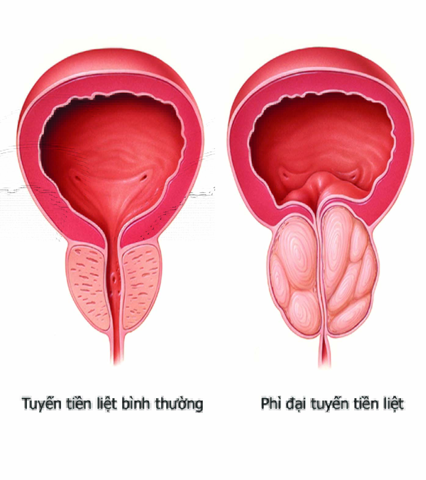 Điều trị u xơ tuyến tiền liệt hiệu quả