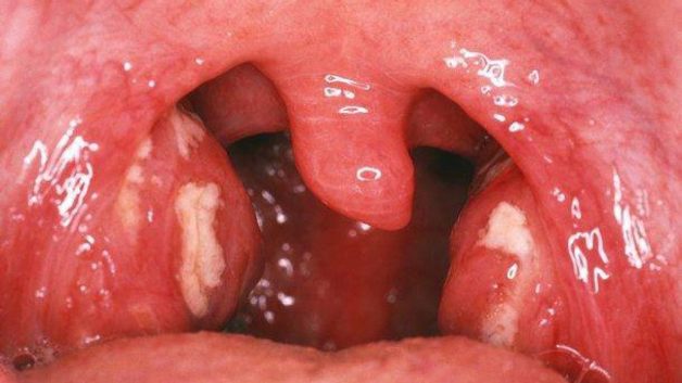 Viêm amidan có mủ có nghiêm trọng không?
