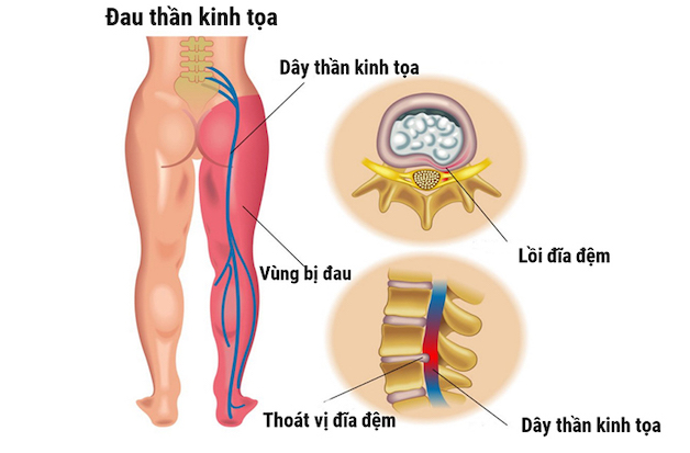 bệnh đau thần kinh tọa có chữa khỏi không