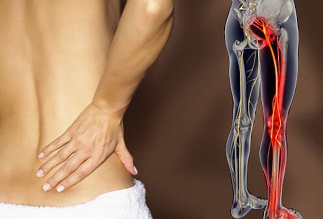 Đau thần kinh tọa tập thể dục như thế nào hiệu quả