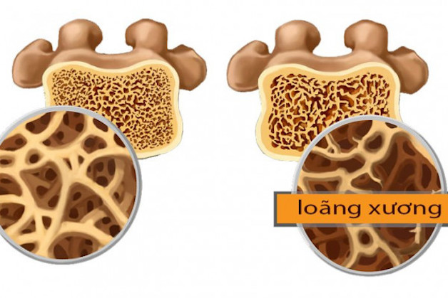 tìm hiểu về loãng xương độ 3
