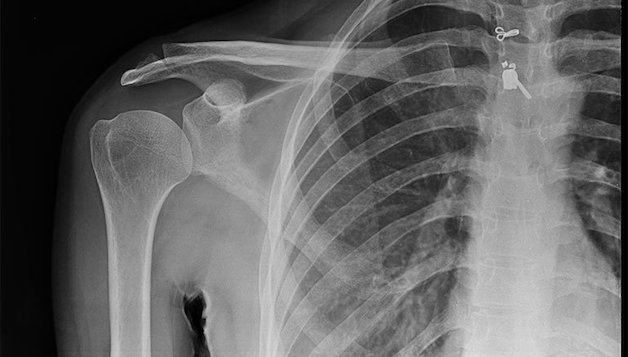 tìm hiểu về viêm khớp vai trái