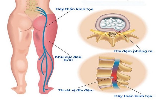 xoa bóp chữa đau thần kinh tọa