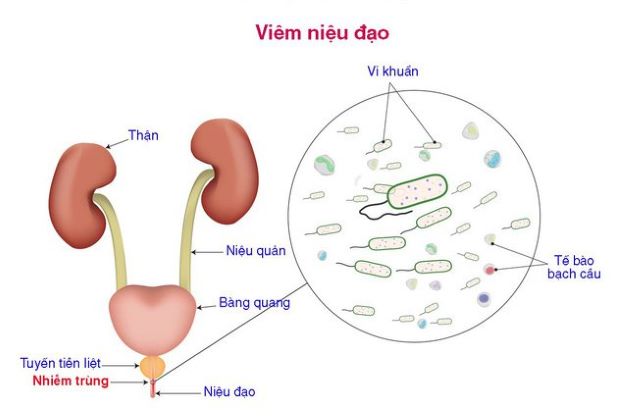 Khi bị hẹp bao quy đầu, các loại vi khuẩn sẽ tận dụng cơ hội này để xâm nhập và tấn công, chúng không chỉ tồn tại ở bao quy đầu mà còn sinh sôi ở các vùng khác, đặc biệt là niệu đạo.