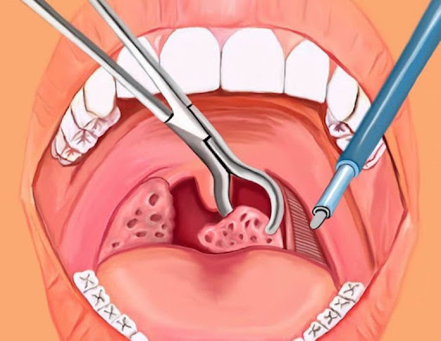bệnh viêm amidan có chữa được không