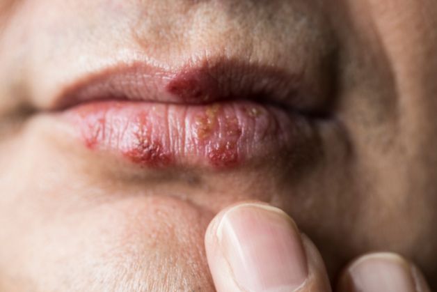 Hình ảnh mụn rộp sinh dục xuất hiện trên khóe miệng