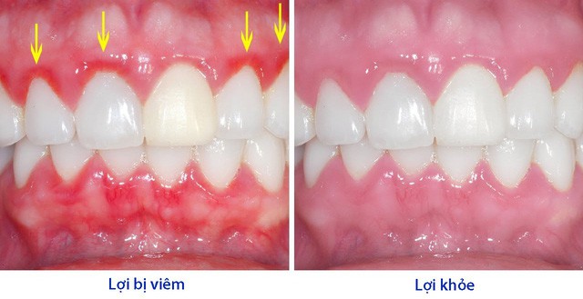 Hình ảnh bình thường của lợi và hình ảnh lợi viêm