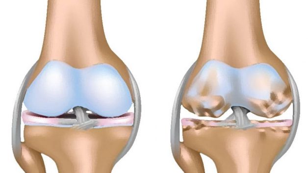 Khô dịch khớp và những ảnh hưởng của bệnh