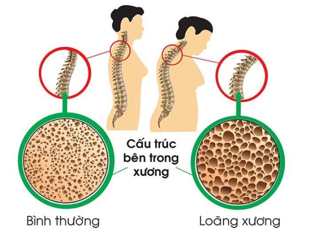 loãng xương và cách điều trị như thế nào