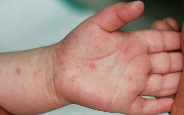 Trẻ em bị tay chân miệng khiến không ít phụ huynh lo lắng đặc biệt là trẻ nhỏ dưới 5 tuổi.