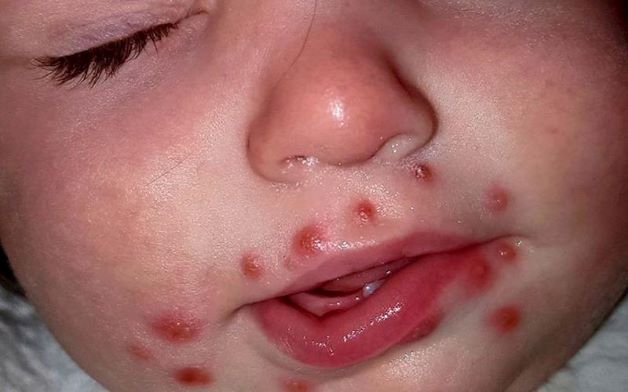 Trẻ bị nổi ban đỏ trên da: Những nốt ban có màu hồng thường không ngứa, không đau, dạng phỏng nước và có đường kính từ 2 đến 5mm,