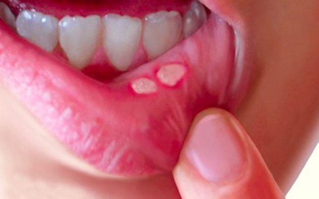 Nhiệt miệng là căn bệnh thường gặp ở mọi người