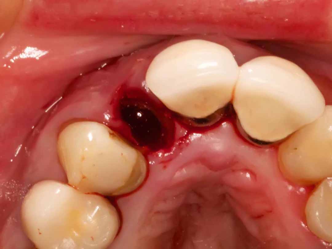 Sau nhổ răng khôn, tình trạng chảy máu có thể kéo dài