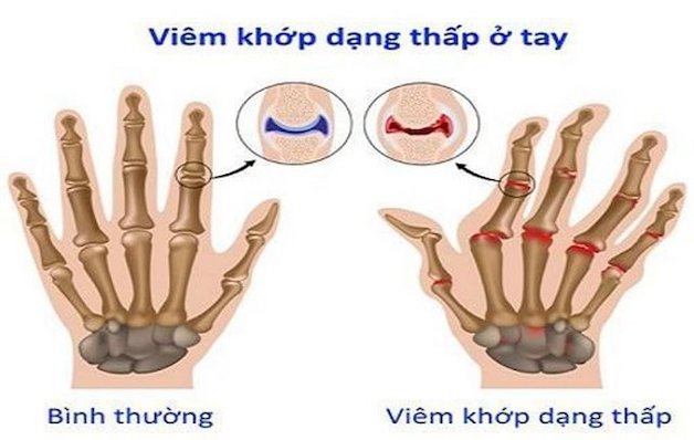 viêm đa khớp dạng thấp là gì