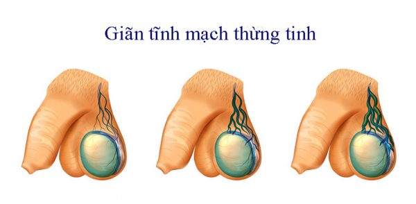 Giãn tĩnh mạch thừng tinh là hiện tượng giãn bất thường của tĩnh mạch bên trong bìu