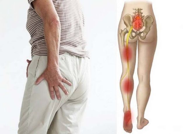 đau thần kinh tọa như thế nào