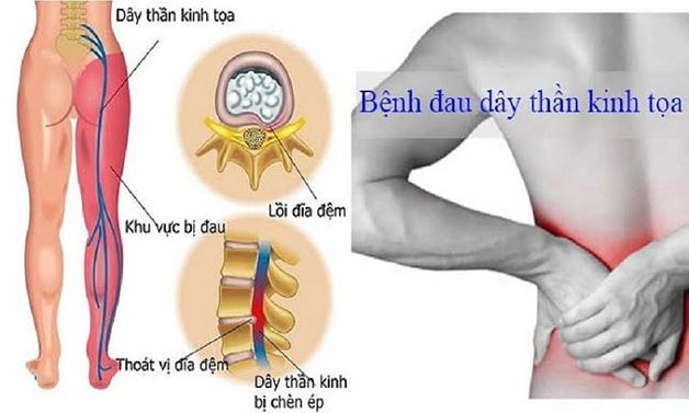 biến chứng nguy hiểm của đau thần kinh tọa