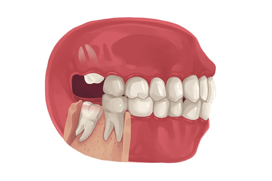 Răng khôn không có chức năng gì, ngược lại còn gây đau đớn và biến chứng cho sức khoẻ người bệnh