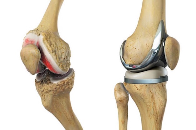 phẫu thuật thay khớp gối toàn phần